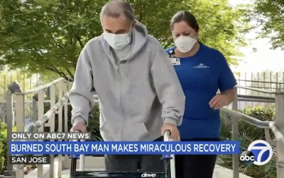 Severely-burned Bay Area man with 20% chance to live makes miraculous recovery