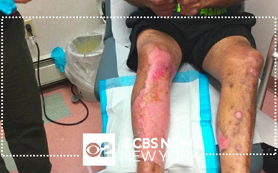 Long Island man among first deep burn patients treated with NexoBrid, a cream derived from pineapples